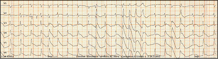 Oflidis - Figure 3. ECG on day 5: Auto-terminated episodes of polymorphic ventricular tachycardia