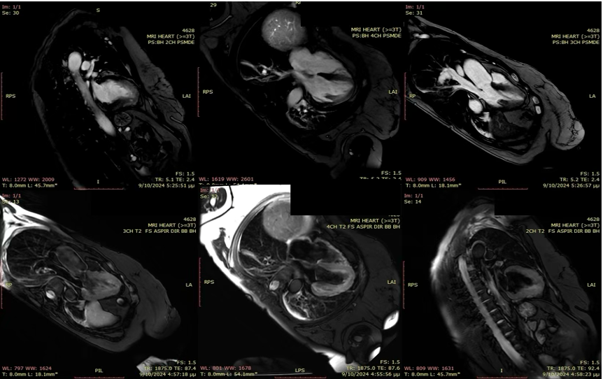 Oflidis - Figure 4. CMR showing diffuse oedema in apical and mid planes and absence of delayed enhancement