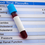 Real-world efficacy of inclisiran- data from a tertiary lipid clinic