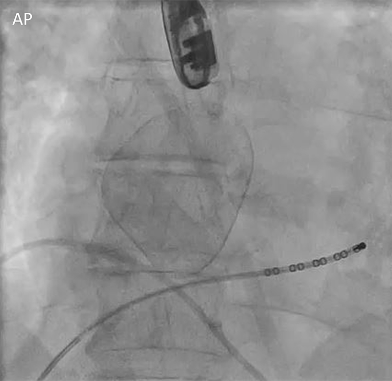 Binani - Figure 1. Anteroposterior (AP) fluoroscopy image of the mass as seen prior to ablation. There is a decapolar catheter in the coronary sinus and a transoesophageal echo (TOE)probe at the top of the image