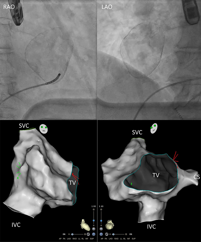 Binani - Figure 2. Right anterior oblique (RAO) (left panels) and left anterior oblique (LAO) (right panels) fluoroscopy (upper panels) and corresponding 3D electroanatomic images (lower panels). The 3D maps created show a scalloped appearance corresponding to the contour of the mass as seen in fluoroscopy. There is distortion of the anterolateral tricuspid annulus, best seen in the lower right panel