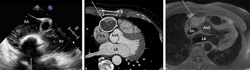 Binani - Figure 3. Panel image of transoesophageal echocardiography (TOE), computed tomography (CT) and magnetic resonance imaging (MRI) of the mass. The blue arrows indicate the mass. The top panel shows TOE image with a fluid-filled mass with echo-bright walls lying in the atrioventricular groove. There is concomitant bubble injection seen in the right atrium (RA) and right ventricle (RV), but not in the mass. The middle panel shows a transverse CT image showing a circular fluid-filled mass in the anterior mediastinum with calcified walls measuring 44.7 × 38.2 mm. The bottom panel shows a cardiac MRI T1 phase image of the mass with heterogenous fluid signal