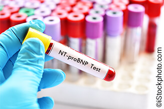 Madu - Retrospective implementation of BSE age-specific NT-proBNP criteria for triage of suspected heart failure