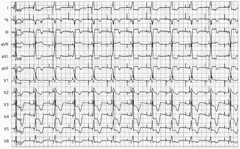 Salisbury - Figure 1. Typical electrocardiogram (ECG) post-left bundle-branch area pacing (LBBAP). Terminal R-wave in V1, narrow QRS