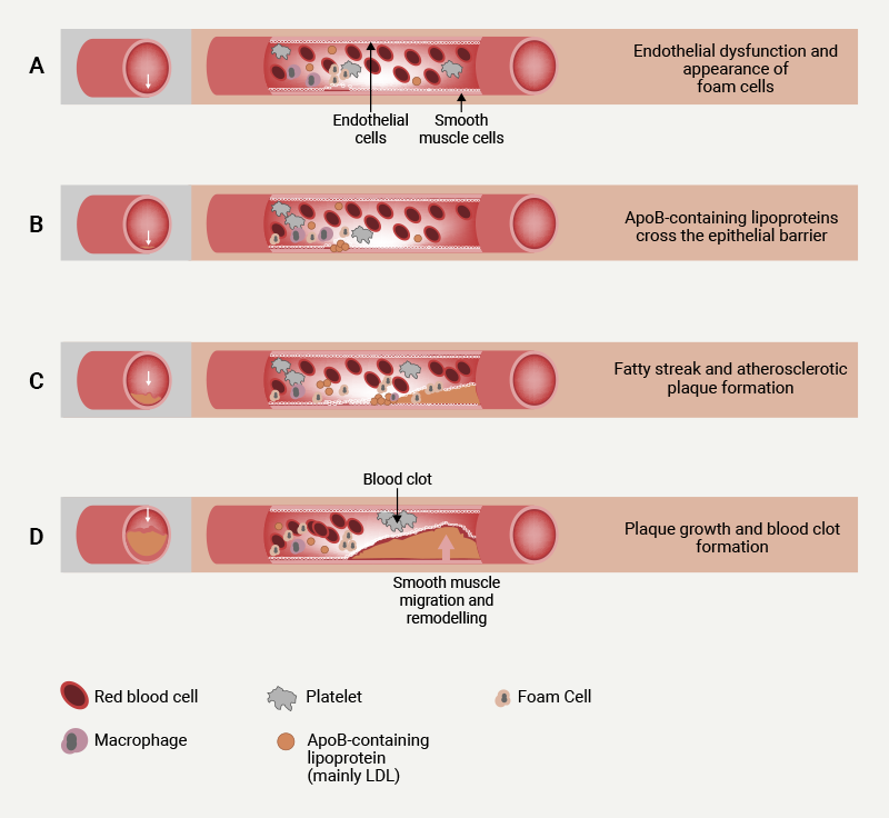 BEACON - Figure 1. Biological mechanisms underlying atherosclerotic plaque development (atherogenesis)