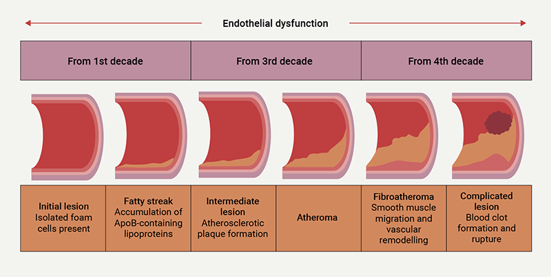 BEACON - Figure 2. Development of atherosclerosis begins during childhood and develops over a lifetime