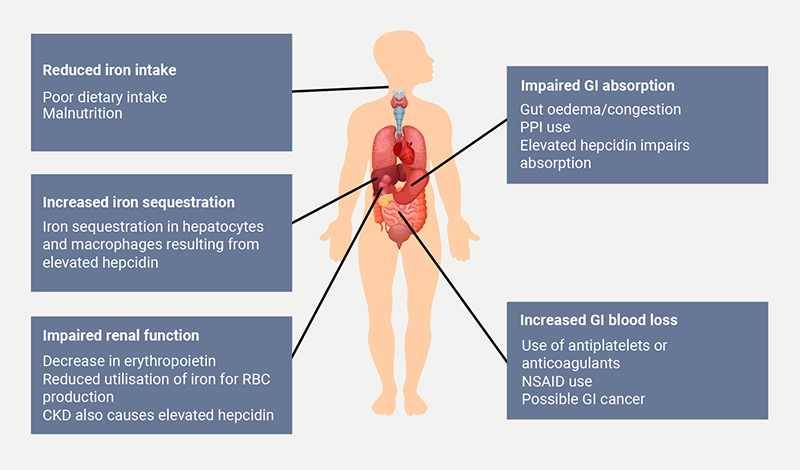 Chotalia - Figure 1. Mechanisms of iron deficiency in heart failure