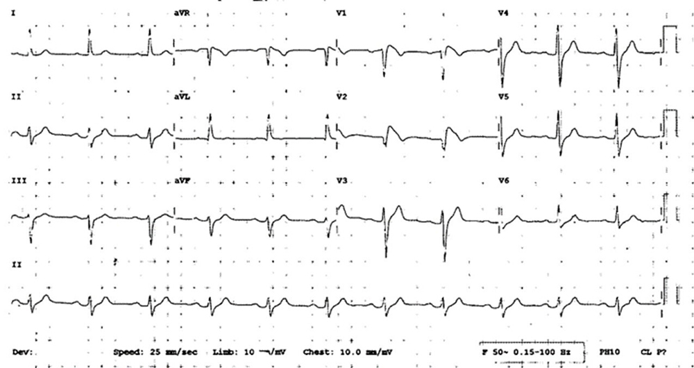 Coutts - Figure 1. The patient’s first diagnostic electrocardiogram (ECG) in 2013, characterised by coved ST-segment elevation (>2 mm) with J-point amplitude and a negative T-wave inversion in leads V1–V2