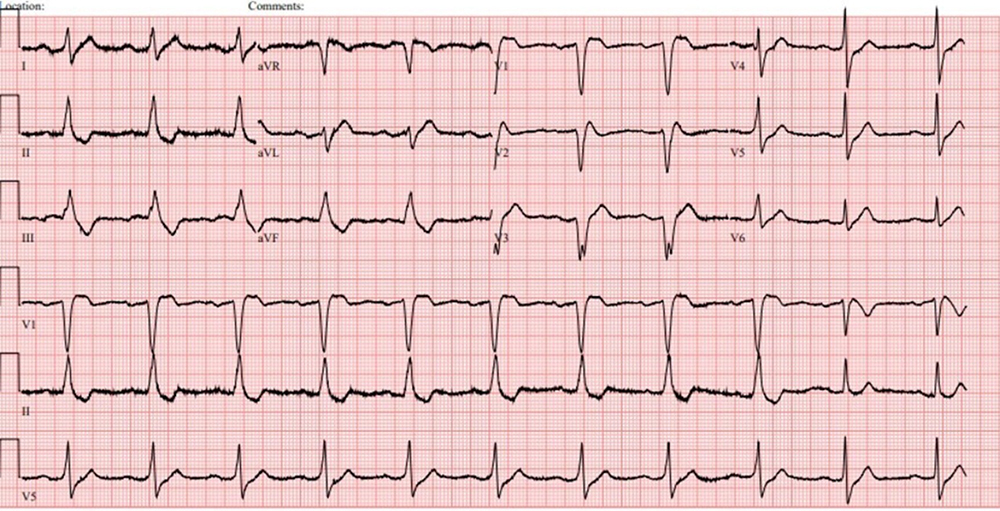 Coutts - Figure 2. The patient’s ECG at presentation (2024) at the district general hospital (DGH) with chest pain shows broadening of the QRS duration with early precordial ST-elevation, in keeping with his known history of Brugada syndrome