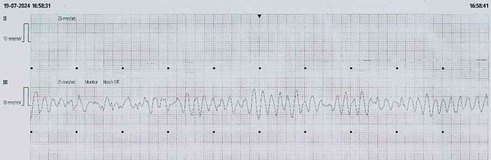 Coutts - Figure 3. The patient’s continuous cardiac monitoring revealing polymorphic ventricular tachycardia (VT) rhythm during cardiac arrest