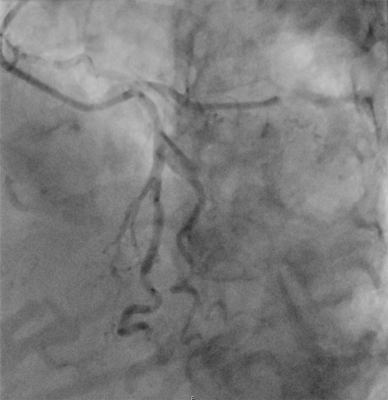 Kahn - Figure 2. Coronary angiogram of the left coronary artery showing occluded circumflex from mid-vessel and left anterior descending artery from distal vessel secondary to thromboembolism