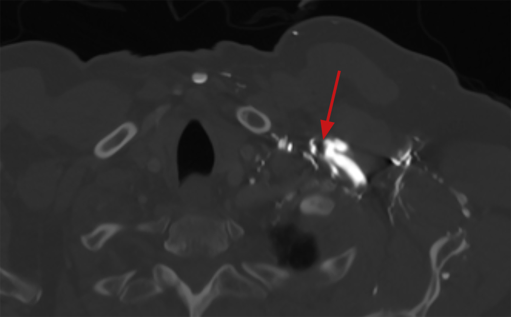 Ruck - Figure 1. Axial view of thrombus in the distal subclavian vein around the pacemaker lead