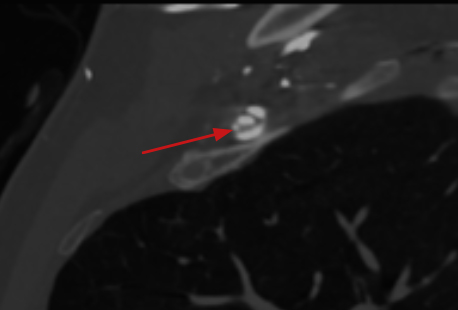 Ruck - Figure 2. Sagittal view of thrombus in the distal subclavian vein around the pacemaker lead