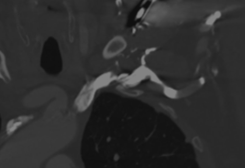 Ruck - Figure 3. Computed tomography (CT) imaging following anticoagulation, showing resolution of the proximal thrombus with some chronic thrombus around the pacing leads