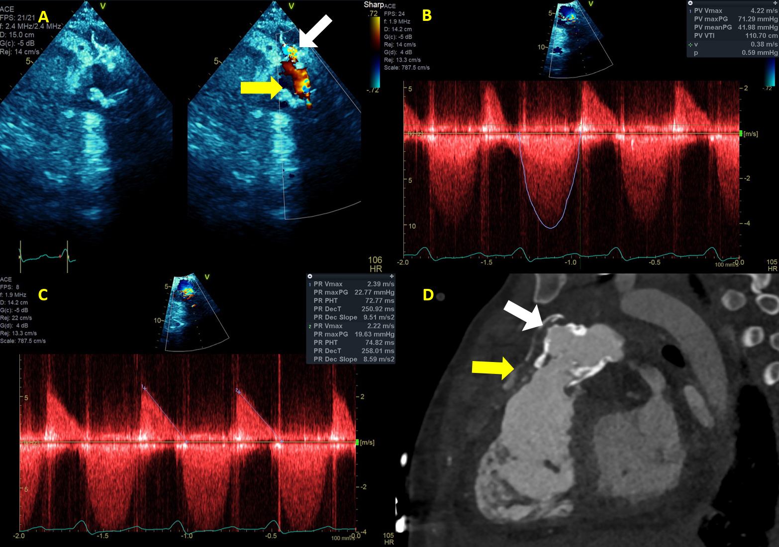Lankaputhra - Figure 1. Pre-operative transthoracic echocardiogram (A) of the right-ventricle-to-pulmonary-artery (RV-PA) conduit (yellow arrow) with colour flow Doppler demonstrating significant flow acceleration and regurgitation across the narrowed valve and communication with a probable abscess (white arrow). Continuous wave Doppler profile confirms significant pulmonary valve stenosis with elevated gradient (peak gradient: 72 mmHg; reference cut-off: <36 mmHg) (B) and significant regurgitation (short pressure half time: 73 ms [severe <100 ms]; dense jet with early diastolic flow termination) (C) across the valve. D: Computed tomography of the pulmonary arteries demonstrating the RV-PA conduit (yellow arrow) with significant calcification and outpouching consistent with abscess formation (white arrow).