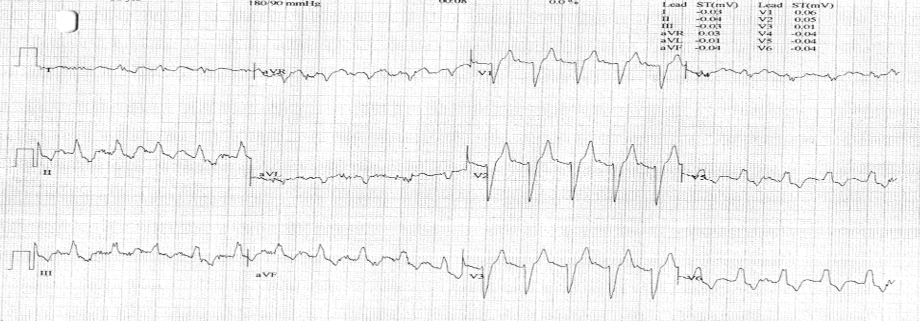 Rafi - Figure 2. ECG performed post-exercise tolerance test (ETT)